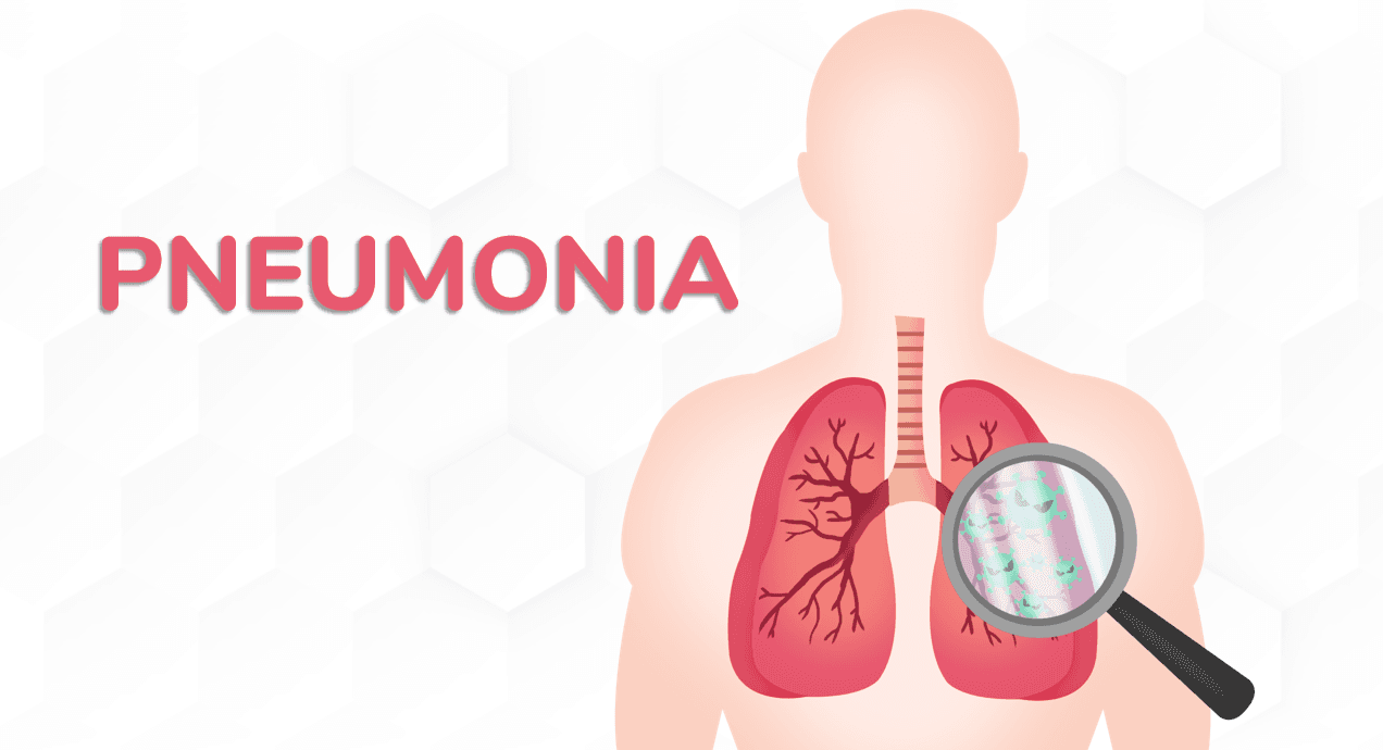 CNN Classification for Pneumonia using lungs X-ray